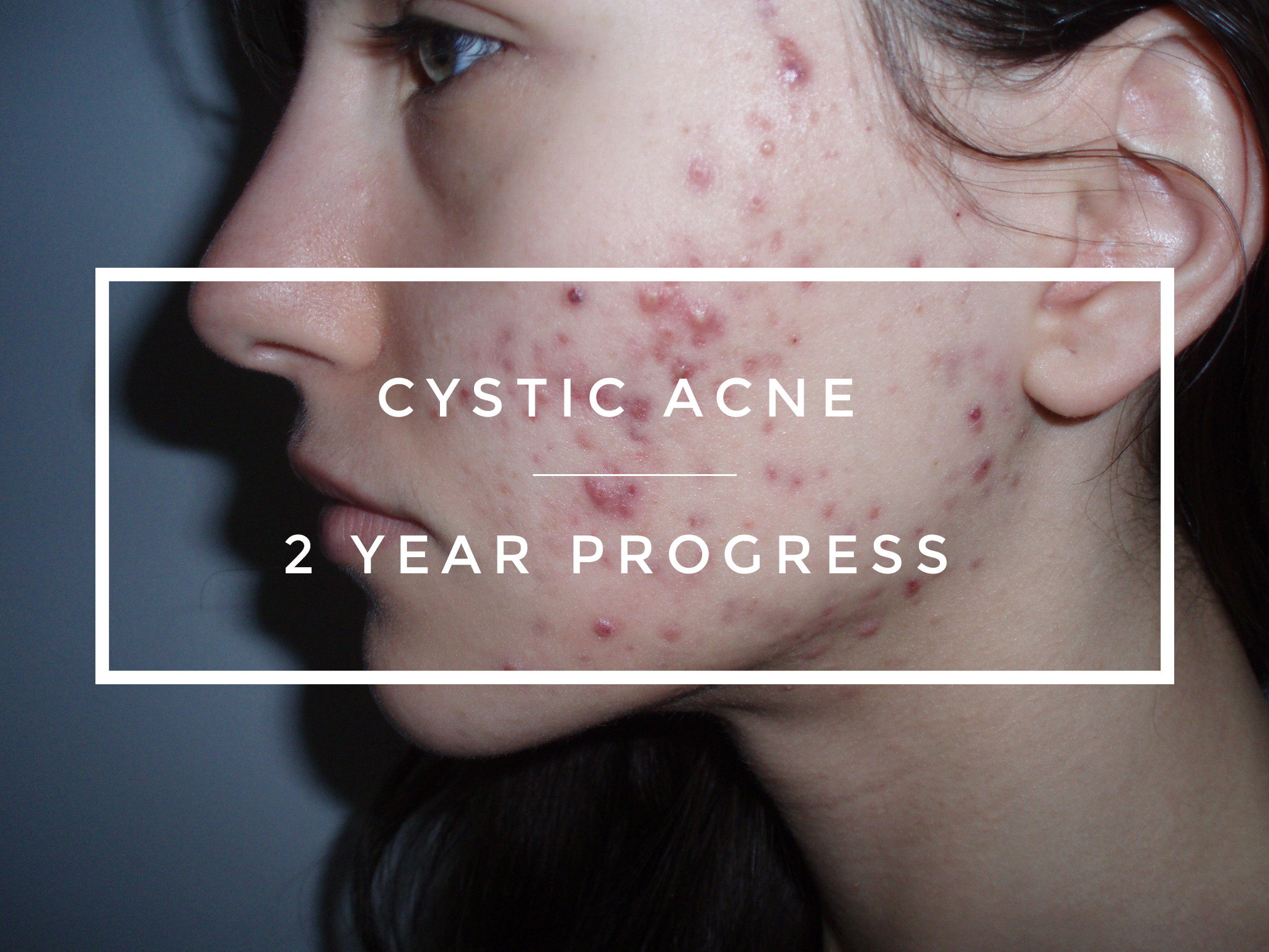 How I Cured My Cystic Acne Update: 1 Year After Probiotics