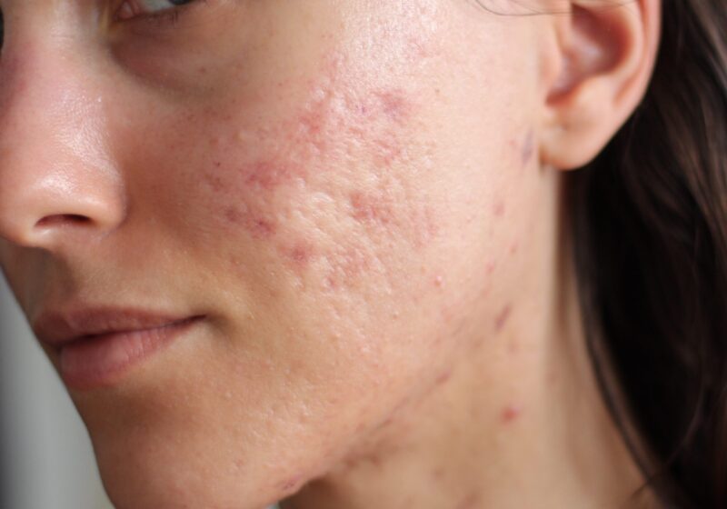 Microneedling Dermapen acne scars review experience